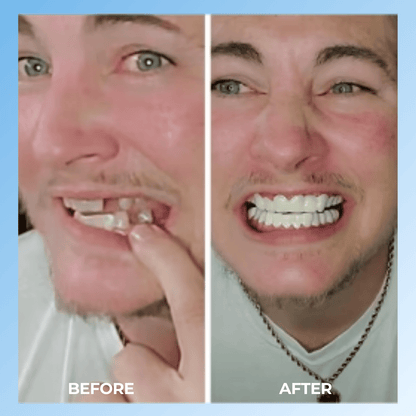 BrightSmile™ - Clip-On Teeth-Veneers