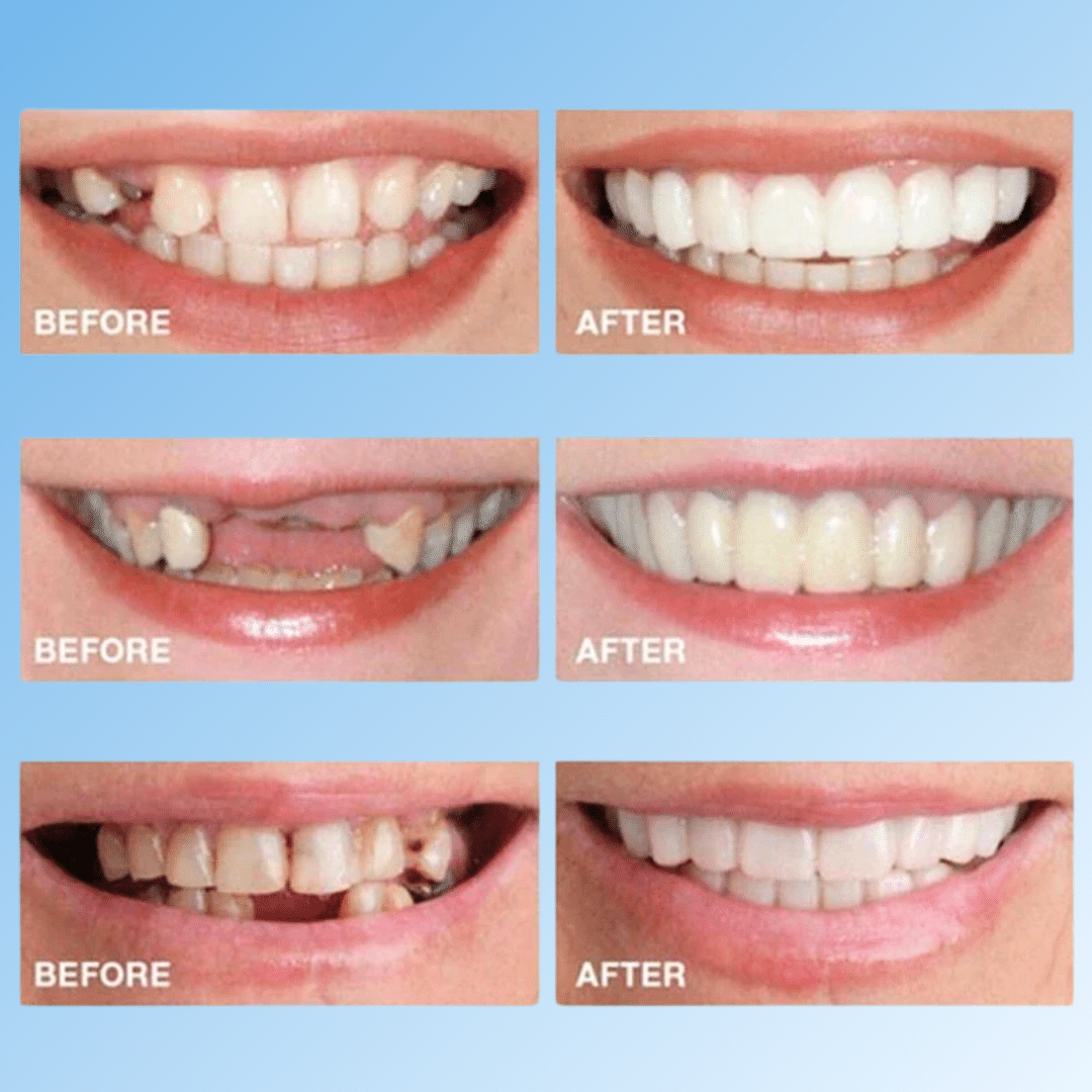 BrightSmile™ - Clip-On Teeth-Veneers